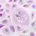 Şişin yaratdığı B hüceyrə dəyişiklikləri üçlü mənfi döş xərçəngində müalicəyə cavab üçün potensial biomarker aşkar edir