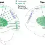 Şizofreniyanın açılması: Genetik və ətraf mühitin qarşılıqlı təsirinə dair yeni anlayışlar