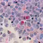 Yeni işıq əsaslı texnika prostat xərçənginin erkən aşkarlanmasında 90% dəqiqlik göstərir