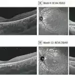 Keçici işemik hücumun əsl nəticəsi sürətlənmiş koqnitiv tənəzzüldə tapıla bilər