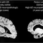 Neyrocərrahiyyə zamanı real vaxt rejimində DNT analizi fərdi beyin şişinin müalicəsini təklif edir