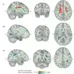 Cənubi Amerikada yarasalarda MERS-ə bənzər ilk koronavirus aşkarlanıb