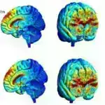 Beyin-mapping texnikası Alzheimer zülalının yığılmasına həssas olan yaddaş hüceyrələrini müəyyən edir