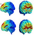 Beyin-mapping texnikası Alzheimer zülalının yığılmasına həssas olan yaddaş hüceyrələrini müəyyən edir