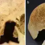 Neyrocərrahiyyə zamanı real vaxt rejimində DNT analizi fərdi beyin şişinin müalicəsini təklif edir