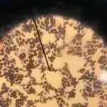 Beynin immun sistemini modulyasiya etmək Alzheimer xəstəliyində zərərin qarşısını ala bilər