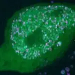 Yuxu pozğunluqları və eşitmə itkisi ümumi bioloji mexanizmləri bölüşür, araşdırma tapır