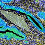 Gecə növbələri təkcə yorucu deyil, həm də ölümcül ola bilər: Yuxu dövrünün pozulması aqressiv döş xərçəngi ilə əlaqələndirilir