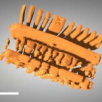 Qadınlarda 30 illik ürək riski ilə əlaqəli həddindən artıq yüksək lipoprotein(a) səviyyələri