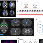 Tədqiqat göstərir ki, təkcə duzlu burun spreyi uşaqların təxminən üçdə birində yuxu pozğunluğu ilə əlaqəli nəfəs alma problemini həll edir