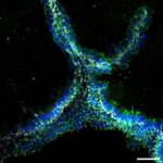 Ağciyər şişləri immun hücumlarından qaçmaq üçün beyindən necə istifadə edir
