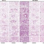 Kolorektal xərçənglə əlaqəli yeni virus kəşf edildi